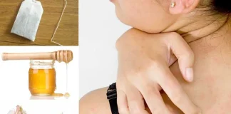 Home Remedies for Shingles Home Remedies for Shingles