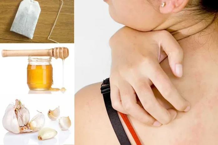 Home Remedies for Shingles
