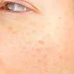 How to Get Rid of Age Spots How to Get Rid of Age Spots
