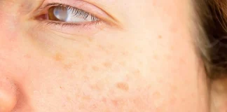 How to Get Rid of Age Spots How to Get Rid of Age Spots