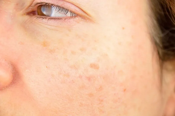 How to Get Rid of Age Spots