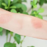 How to Treat Poison Ivy How to Treat Poison Ivy