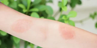 How to Treat Poison Ivy How to Treat Poison Ivy