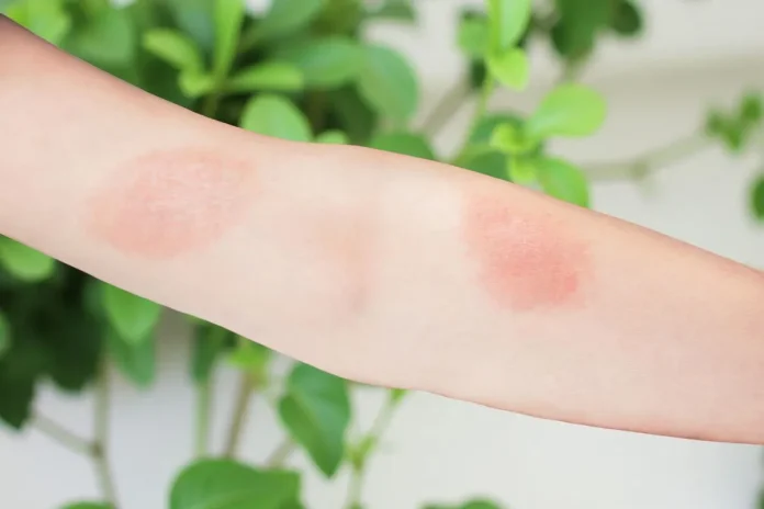 How to Treat Poison Ivy