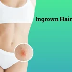 All Facts About Ingrown Hair Cyst: Symptoms, Causes, and Treatment Ingrown Hair Cyst