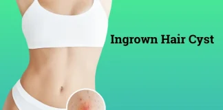 All Facts About Ingrown Hair Cyst: Symptoms, Causes, and Treatment Ingrown Hair Cyst