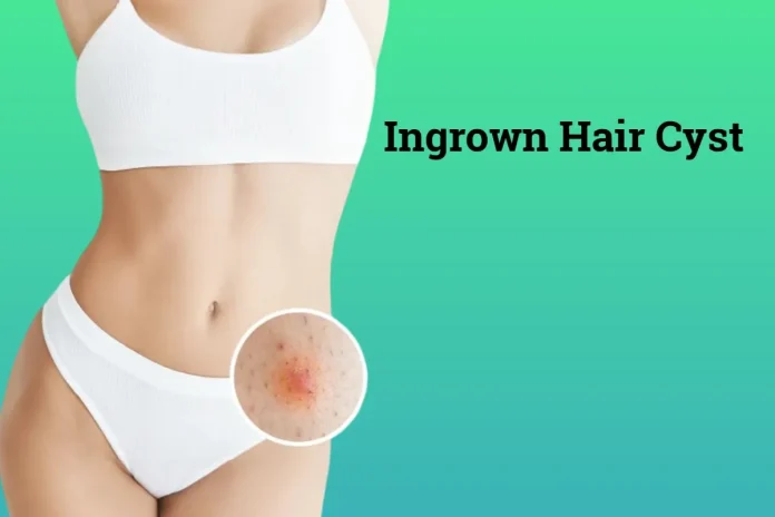 Ingrown Hair Cyst