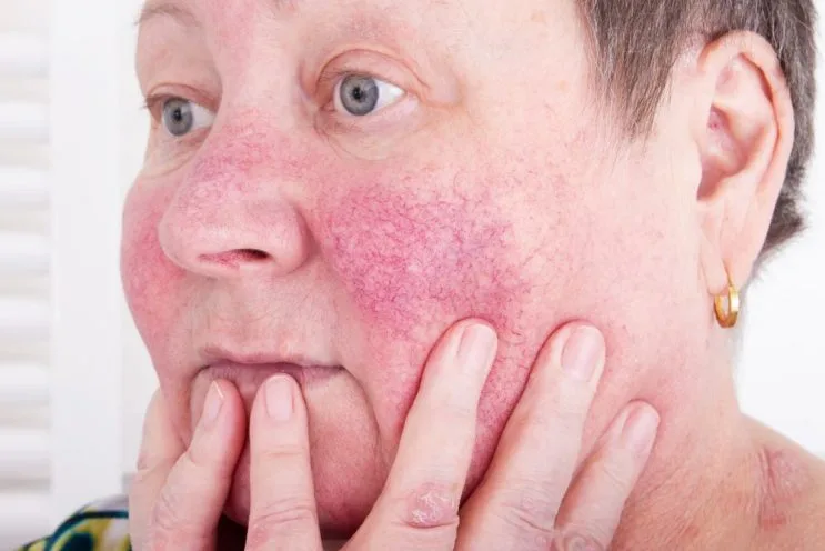 What are rosacea symptoms