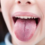 Home Remedies for Geographic Tongue Geographic Tongue