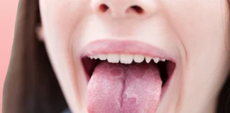 Home Remedies for Geographic Tongue Geographic Tongue
