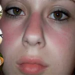 Home Remedies for Lupus Rash Home Remedies for Lupus Rash
