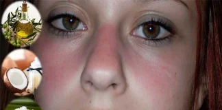 Home Remedies for Lupus Rash Home Remedies for Lupus Rash