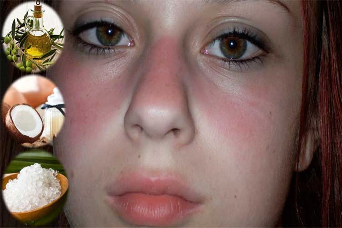 Home Remedies for Lupus Rash Home Remedies for Lupus Rash