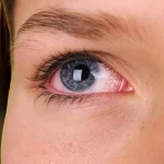 Top 15 Simple But Effective Home Remedies for Red Eyes Home Remedies for Red Eyes