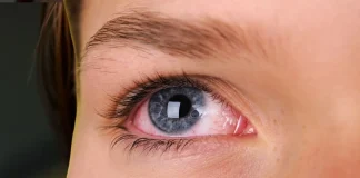 Top 15 Simple But Effective Home Remedies for Red Eyes Home Remedies for Red Eyes