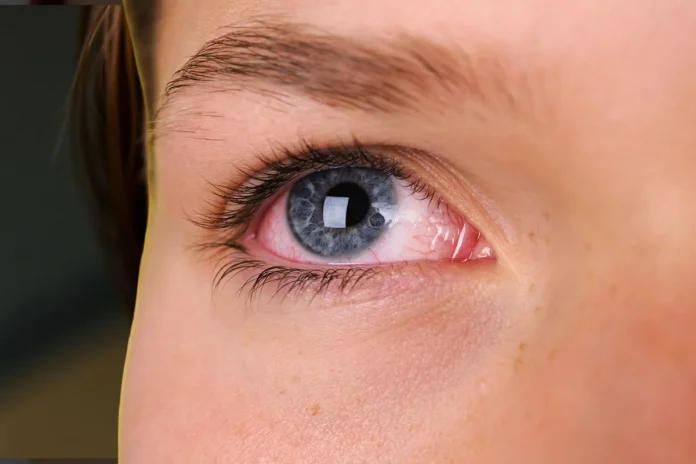 Home Remedies for Red Eyes