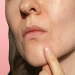 How to Get Rid Of Dry Spots On Face Effectively? How to Get Rid Of Dry Spots