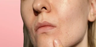 How to Get Rid Of Dry Spots On Face Effectively? How to Get Rid Of Dry Spots