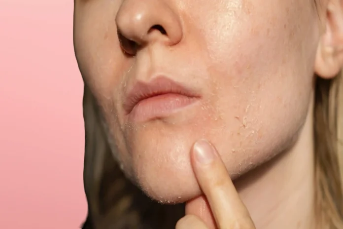 How to Get Rid Of Dry Spots