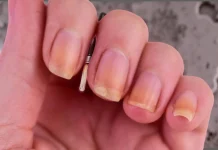 How to Get Rid of Yellow Nails and What You Need to Know About Nail Care