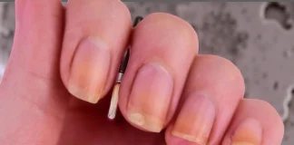 How to Get Rid of Yellow Nails and What You Need to Know About Nail Care