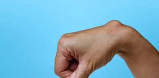 How to Treat a Ganglion Cyst How to Treat a Ganglion Cyst