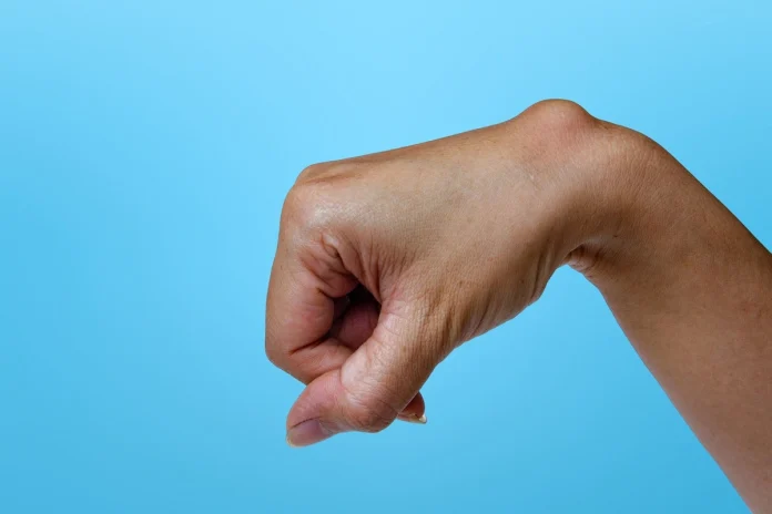 How to Treat a Ganglion Cyst