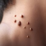 How to Get Rid of Skin Tags Fast How to Get Rid of Skin Tags Fast