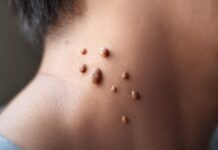 How to Get Rid of Skin Tags Fast How to Get Rid of Skin Tags Fast