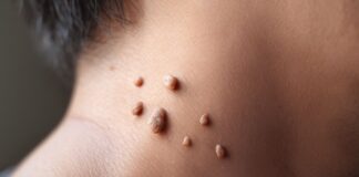 How to Get Rid of Skin Tags Fast How to Get Rid of Skin Tags Fast