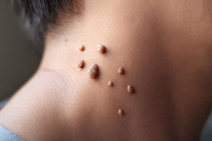 How to Get Rid of Skin Tags Fast