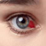 What Is Hyphema? Hyphema