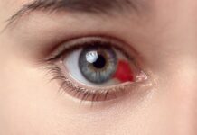 What Is Hyphema? Hyphema