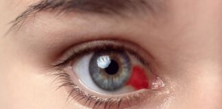 What Is Hyphema? Hyphema
