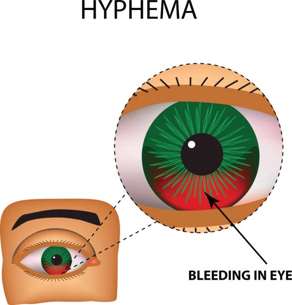What Is Hyphema