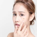 Top 5 Tips To Acne Treatment Acne Treatment