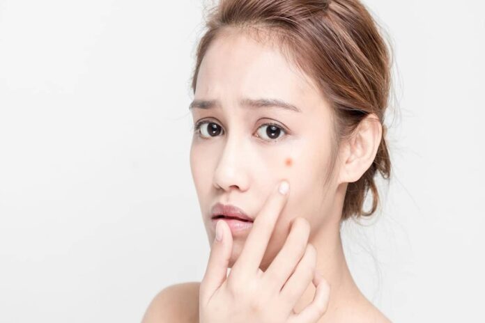Acne-Treatment Acne Treatment