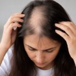 Top 18 Home Remedies for Alopecia – All You Need to Know About Hair Loss