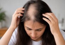 Top 18 Home Remedies for Alopecia – All You Need to Know About Hair Loss