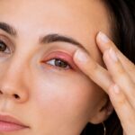 How To Get Rid of A Chalazion: Natural Remedies, Traditional Medicine, Prescribed Medications And Surgery How To Get Rid of A Chalazion