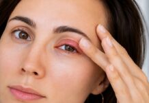 How To Get Rid of A Chalazion: Natural Remedies, Traditional Medicine, Prescribed Medications And Surgery How To Get Rid of A Chalazion
