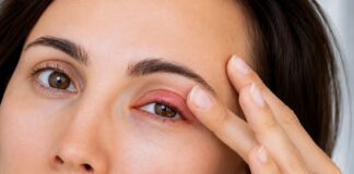 How To Get Rid of A Chalazion: Natural Remedies, Traditional Medicine, Prescribed Medications And Surgery How To Get Rid of A Chalazion