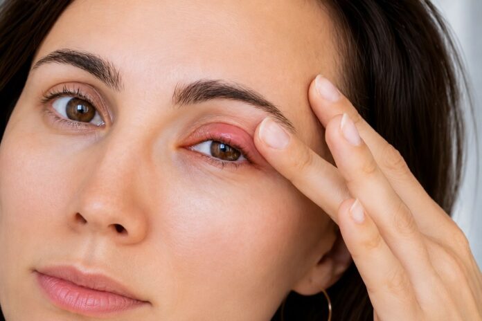 How To Get Rid of A Chalazion How To Get Rid of A Chalazion