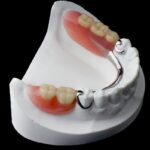 Benefits You Get With Partial Dentures partial dentures