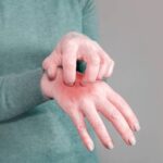 Scabies Treatment and Management Scabies Treatment