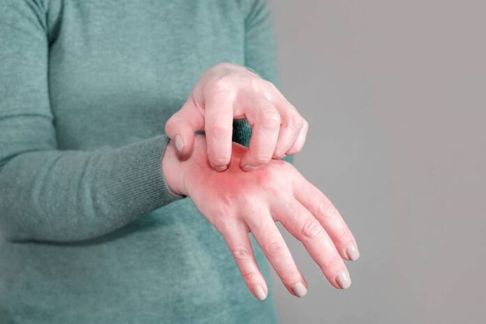 Scabies-Treatment Scabies Treatment