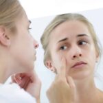 Top 10 Home Remedies For Acne Home Remedies For Acne