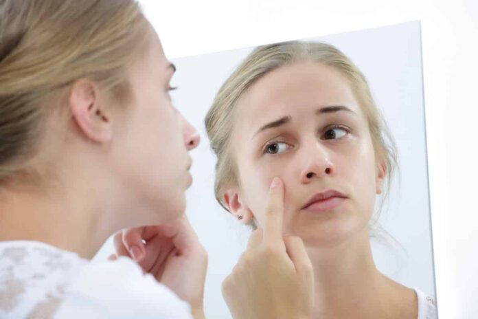 Top-10-Home-Remedies-For-Acne-By-Brians-Ocean-1 Home Remedies For Acne