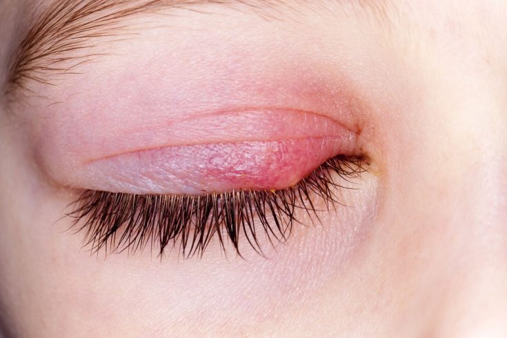 What is a chalazion