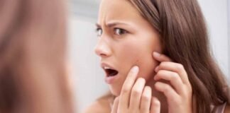 How to Get Rid of Blackheads on Cheeks Safely and Efficiently get rid of blackheads